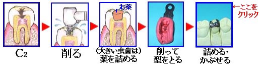C2の虫歯治療