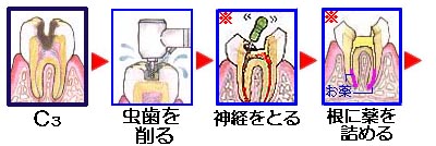 C3の虫歯の治療