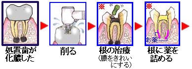 治療歯の再治療