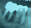 歯槽膿漏で、歯を支える歯槽骨がなくなってぐらついた歯（左）