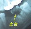 虫歯で歯の頭がなくなり、根も虫歯の場合は抜歯します。