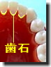 歯の裏についた歯石
