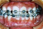 ベッグ法による歯列矯正